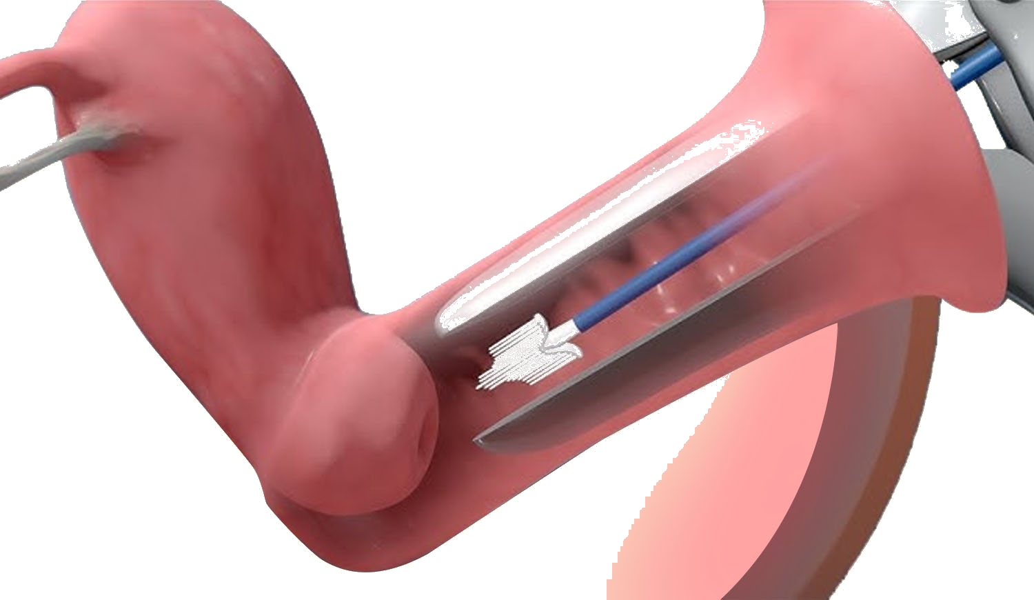 Pap Smear